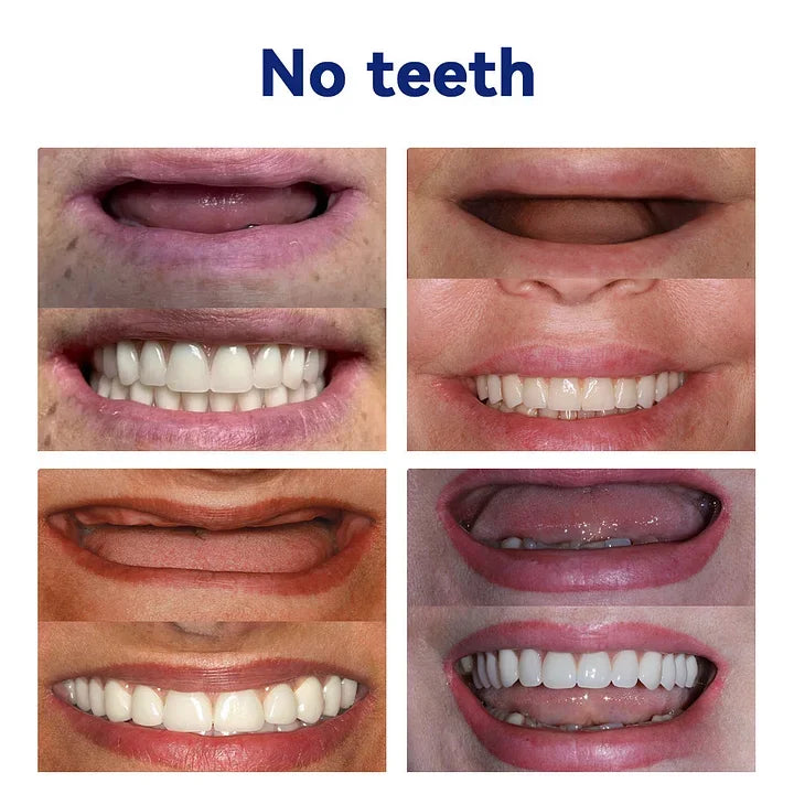 SmileFitPro™ – Lösung der neuen Generation: Flexible Vollprothese