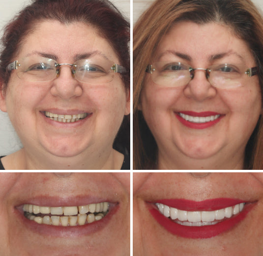 HZA™ Premium Vollprothesen-Set – Individuell anpassbare Zahnprothese